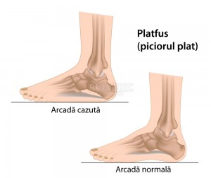 Platfus (picior plat): simptome, cauze, tratament - CSID: Ce se întâmplă Doctore?